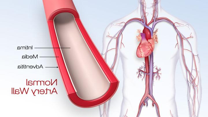 Illustration of atherosclerosis