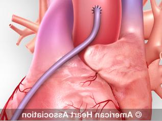 illustration of CABG