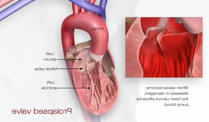 Illustration of a Prolapsed Valve